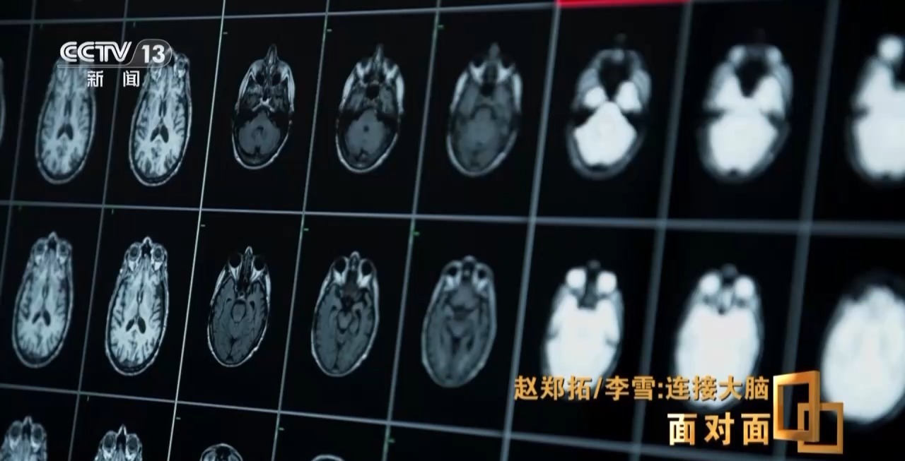 直击脑机接口技术“痛点”,前沿探索正多路并进